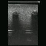 M43E Ultrasound Lumbar Puncture Epidural Simulator
