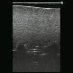 M43E Ultrasound Lumbar Puncture Epidural Simulator