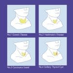 MW62 Thyroid Palpation Simulator