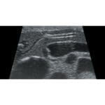 Abdominal Intraoperative Laparoscopic Ultrasound Phantom IOUSFAN US-3