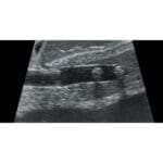 Abdominal Intraoperative Laparoscopic Ultrasound Phantom IOUSFAN US-3