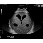 Ultrasound Neonatal Head Phantom US-14A