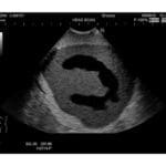 Ultrasound Neonatal Head Phantom US-14A
