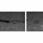 US-21 DVT (Deep Vein Thrombosis) Phantom