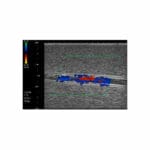 US-21 DVT (Deep Vein Thrombosis) Phantom