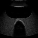 Rectal and Bladder Ultrasound Phantom US23