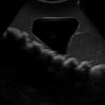 Rectal and Bladder Ultrasound Phantom US23
