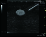 Ultrasound Guided Breast Biopsy Training Model - Duo (Transparent and Opaque) set US-9